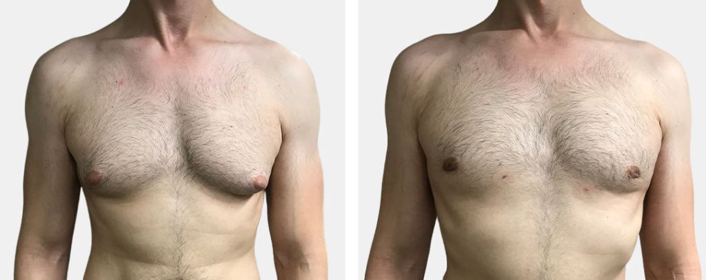 Gynecomastia Surgery and Its Impact on Intimate Relationships