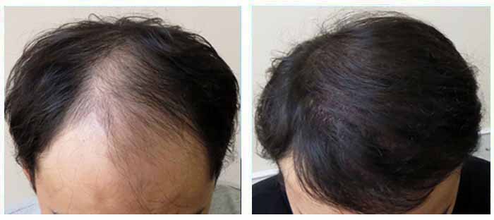 A Guide Towards Recovery From Hair Transplant Surgery