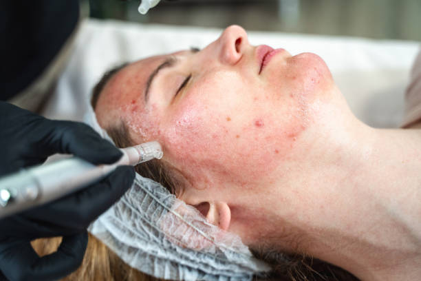 Microneedling: A Guide to Achieving Glowing, Youthful Skin