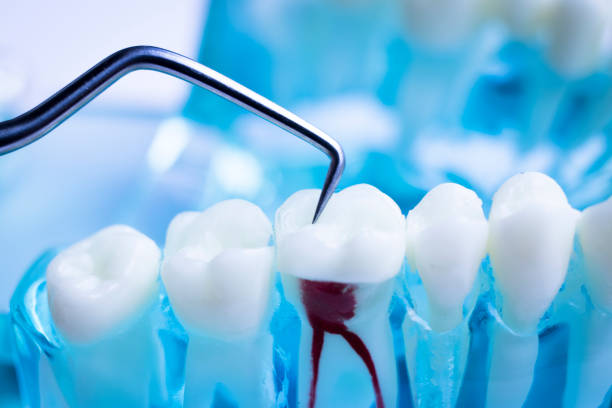 Root Canal Treatment: A Comprehensive Guide