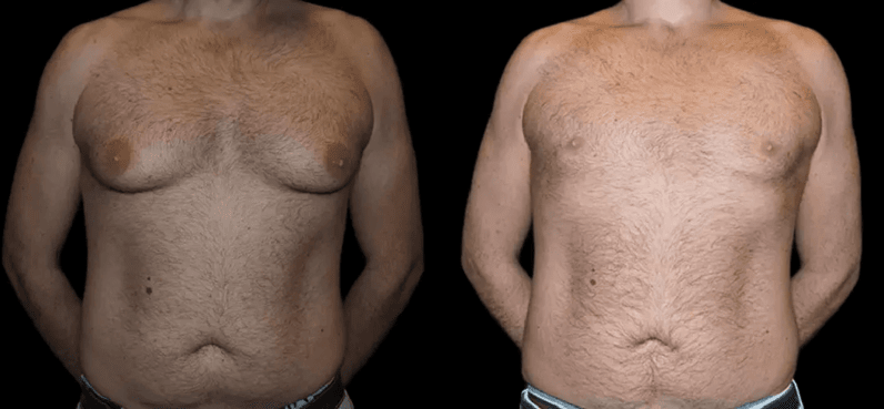 Male Breast Reduction Surgery in Dubai: What You Need to Know