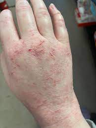 psoriasis treatment