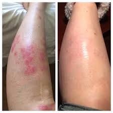 psoriasis treatment