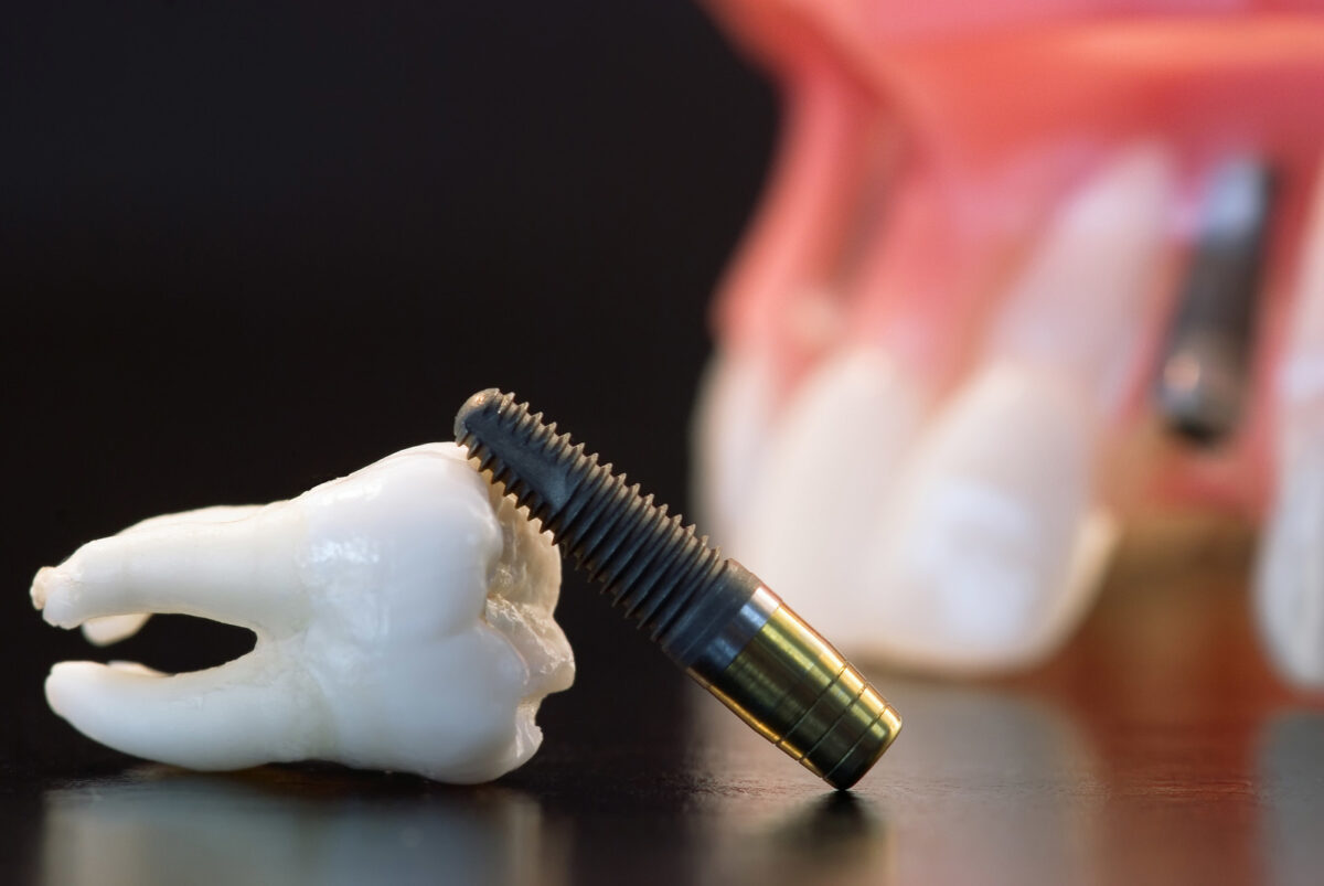 Dental implant cost