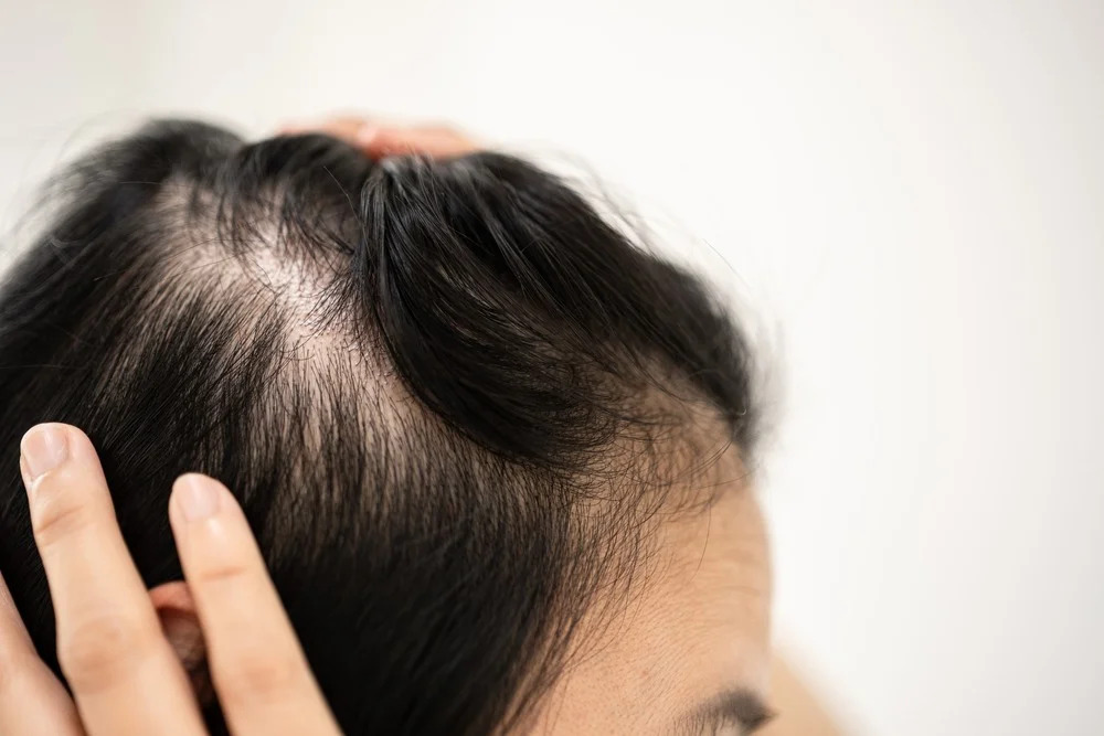 Alopecia Areata Market Size, Share, Analysis, Report & Industry 2032