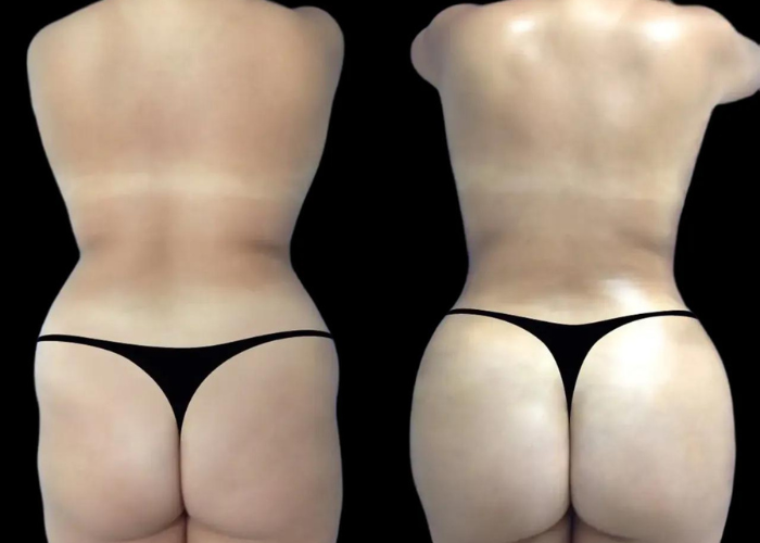 Why Butt Fillers Are a Top Trend in Dubai for 2024