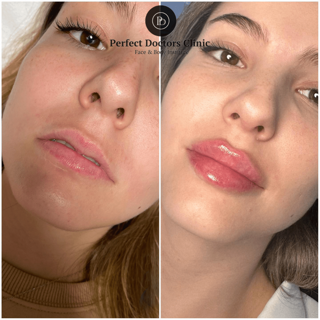 How Juvederm Fillers in Dubai Can Restore Volume to Your Face