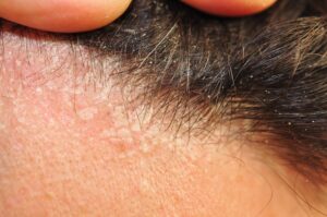 does seborrheic dermatitis cause hair loss