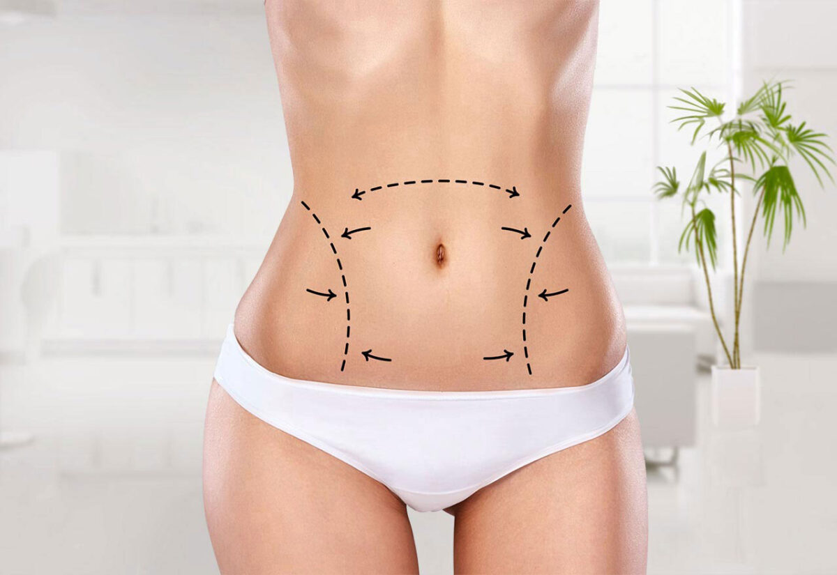 Essential Questions to Ask Before Your Liposuction Surgery in Dubai