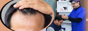 Best Hair Transplant in Jaipur