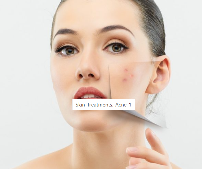 Anti- Acne Treatment in Ahmedabad