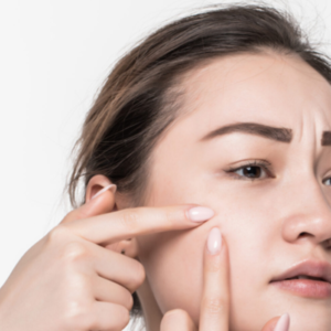 Anti- Acne Treatment in Ahmedabad