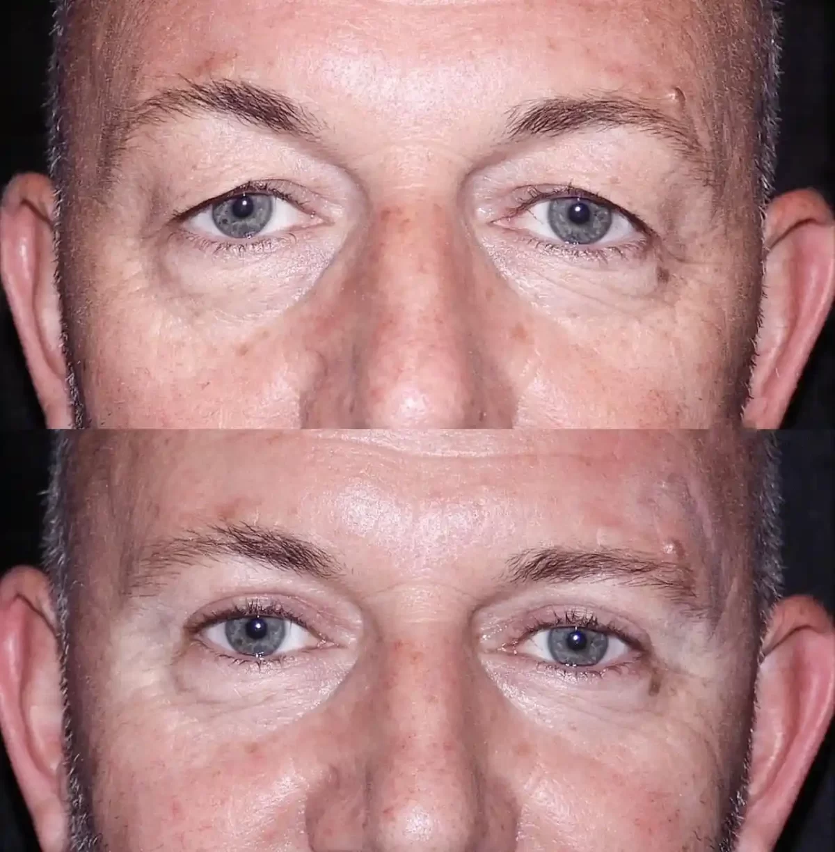 Eye Bag Fat Removal Surgery for Younger Patients