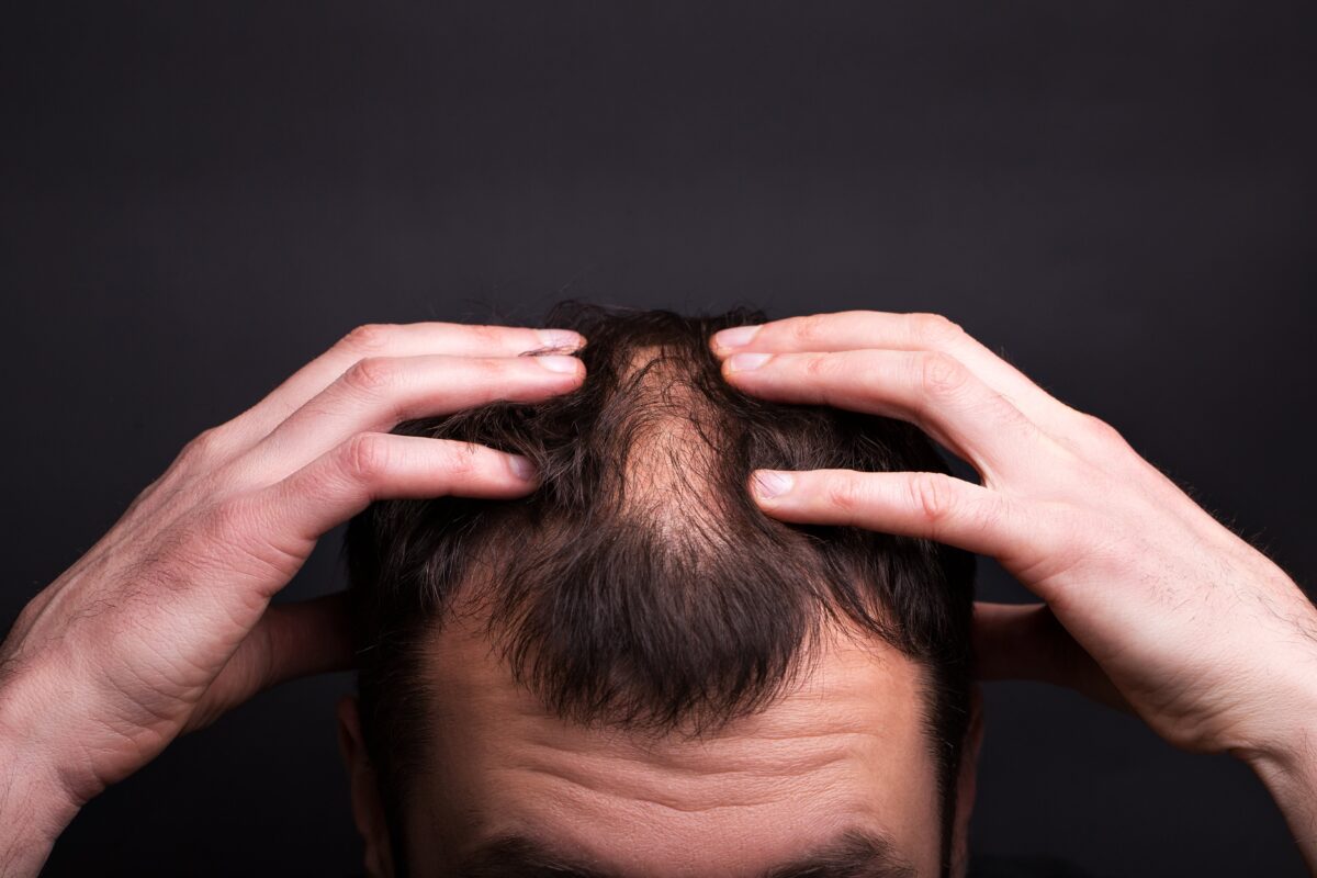 Can hair loss seasonal ? Hair loss treatment