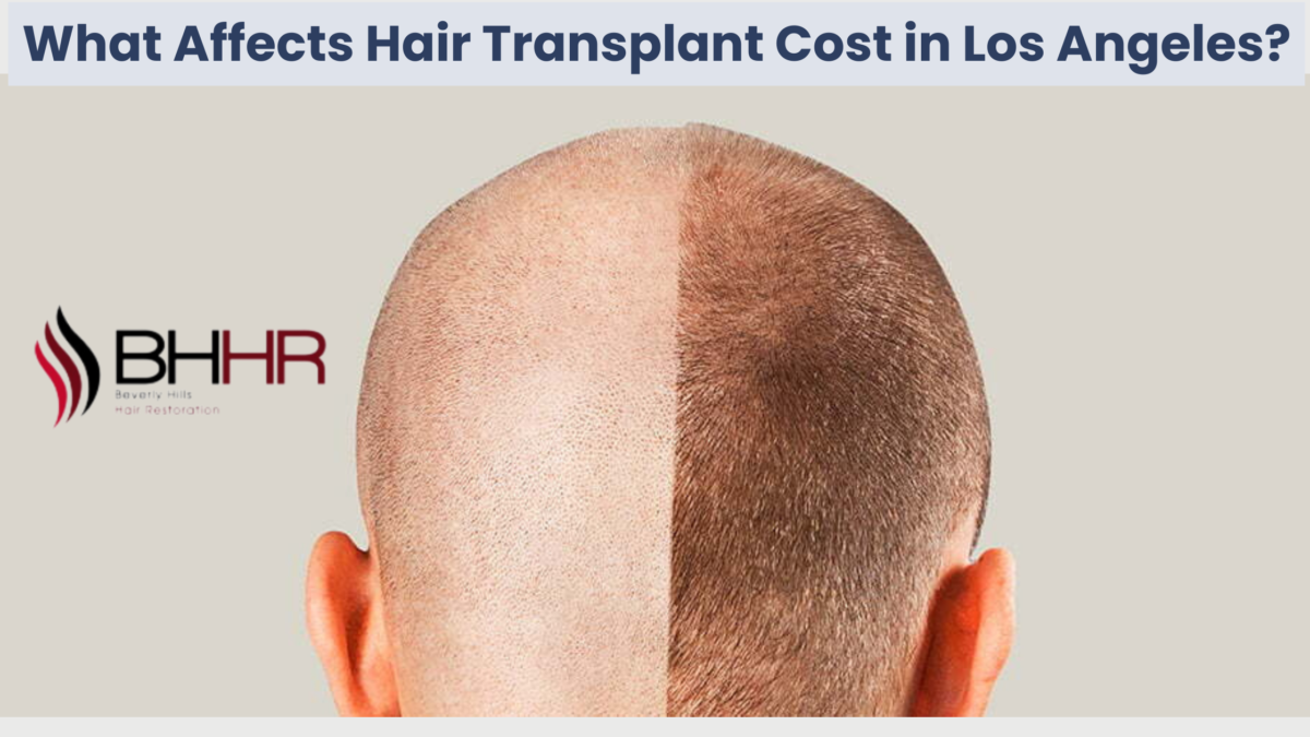 What Affects Hair Transplant Cost in Los Angeles?