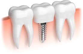 Dental Implants is Long-Lasting Tooth Replacement