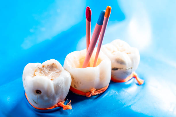 “Root Canal Rescue: The Key to Saving Your Tooth and Relieving Pain”