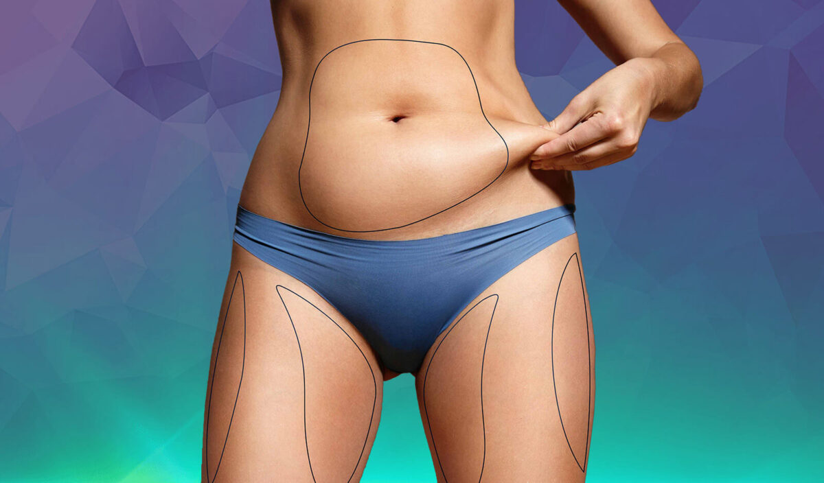 Does the Fat Grow Back After Liposuction?