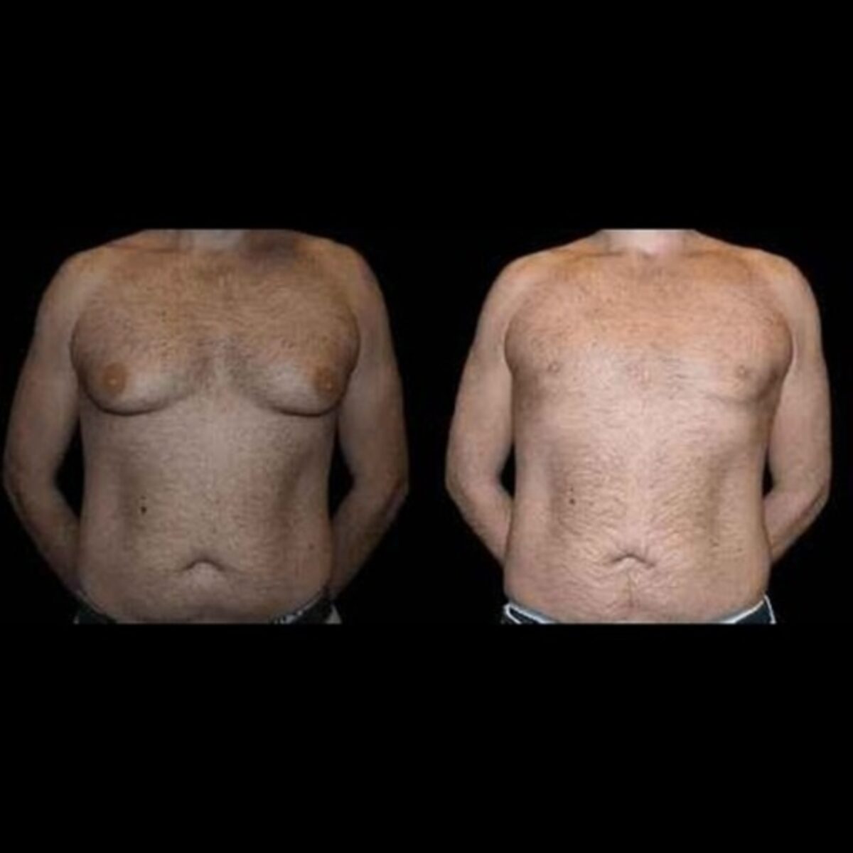 What is Male Breast Reduction Surgery? Who is Good Candidate