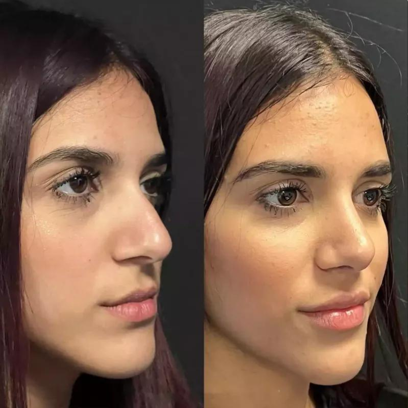 Rhinoplasty in Dubai: Stitch Removal Timeline