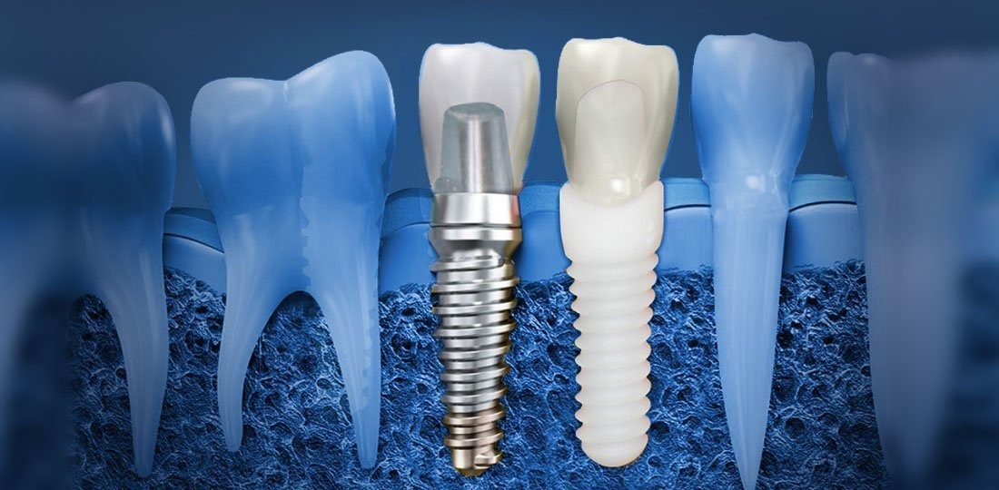 Improving Community Health with Dental Implants in Idaho Falls