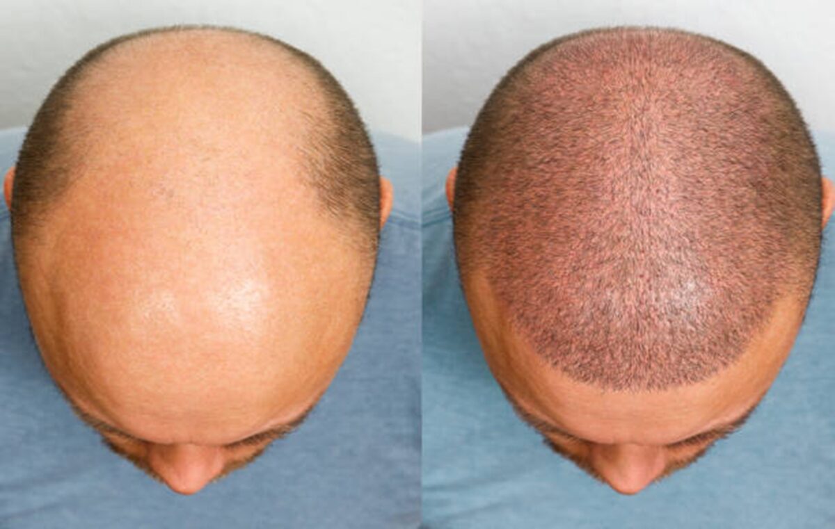 Crown Hair Transplants: A Permanent Fix for Bald Spots