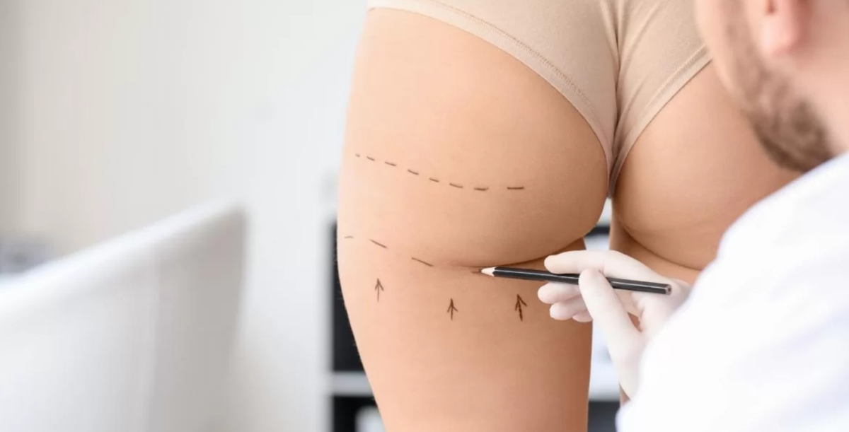 Virtual Consultations Finding the Best Butt Fat Transfer Surgeons in Dubai