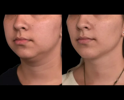 How to Prepare for Double Chin Removal Surgery in Dubai