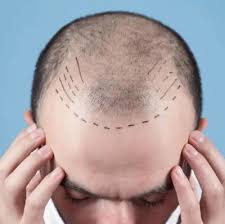 All You Need to Know About Hair Transplants in Riyadh