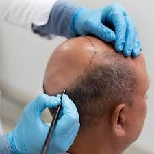 How to Find the Best Value for Hair Transplants in Riyadh