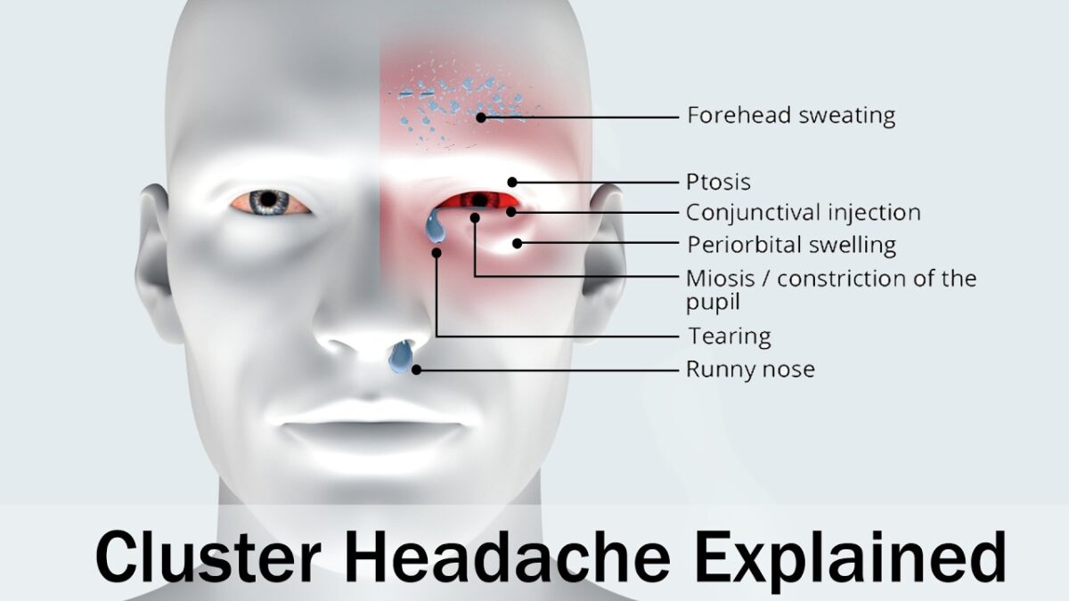 Do Cluster Headaches Impact Physical Fitness or Exercise