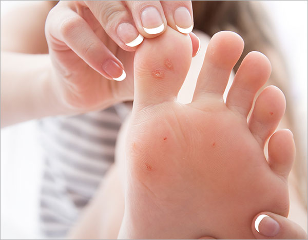 Understanding Corns and Warts: Causes, Symptoms, and Effective Treatments