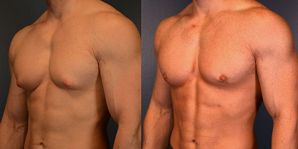 How to Choose the Best Specialist for Gynecomastia in Dubai