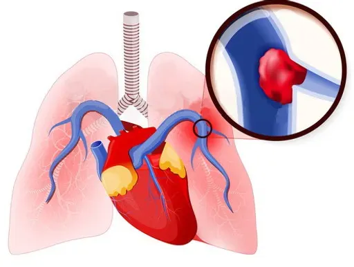 Pulmonary Embolism