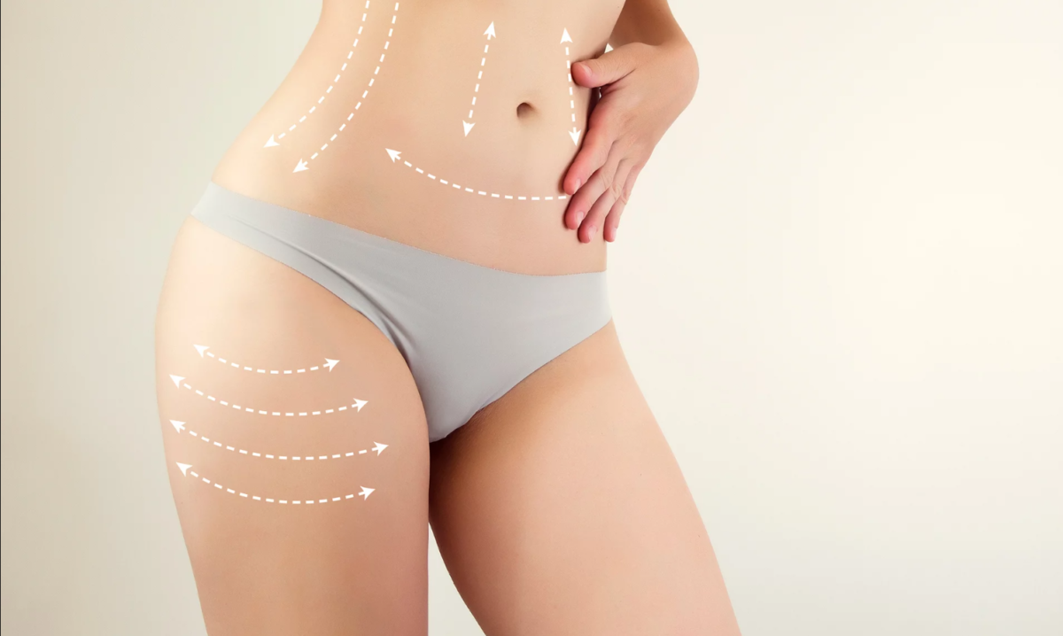 What You Need to Know About Scarring After Liposuction Surgery in Dubai