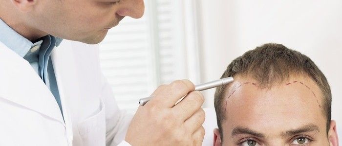 Is the Cost of Hair Transplant Worth It? Here’s What to Consider