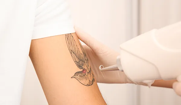 Picosure Tattoo Removal in Dubai