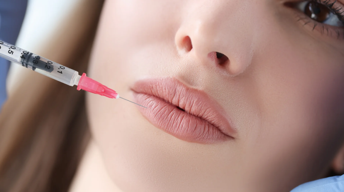 Russian Lip Fillers injections in Dubai