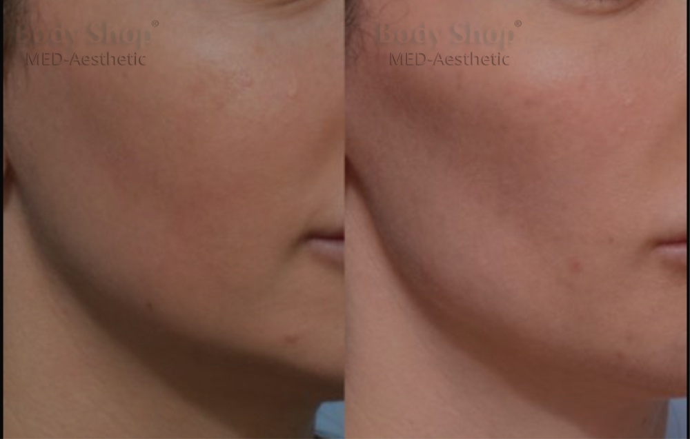 Enhance Your Look with Body Shop MA Jawline Contouring