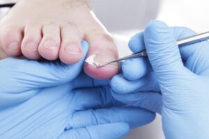 ingrown toenail removal in San Antonio