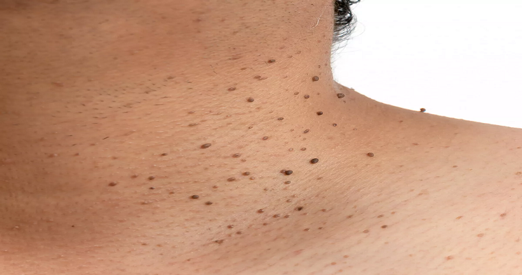 Can Skin Tags Come Back? Understanding Skin Tag Removal in Dubai