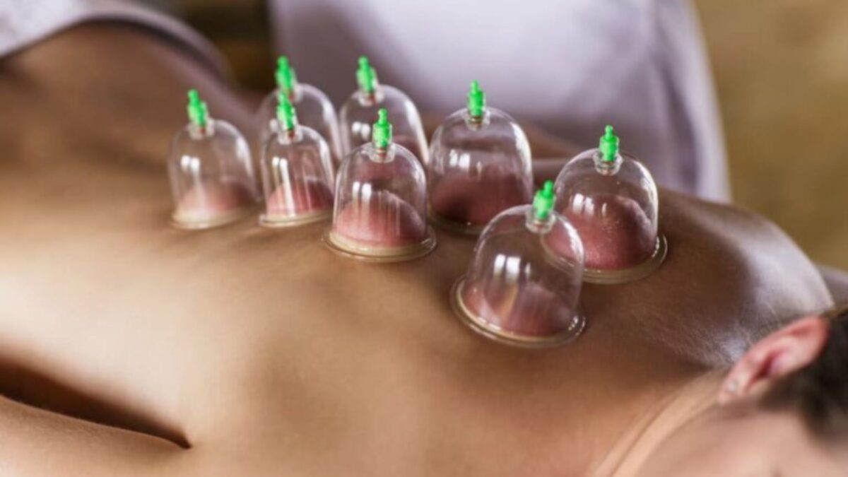 Cupping Therapy for Beginners: 5 Things You Should Know