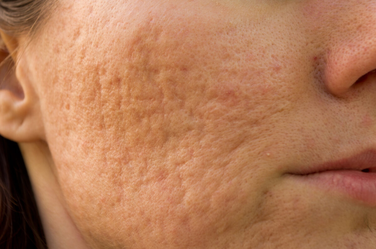 Does laser acne treatment work for cystic acne?