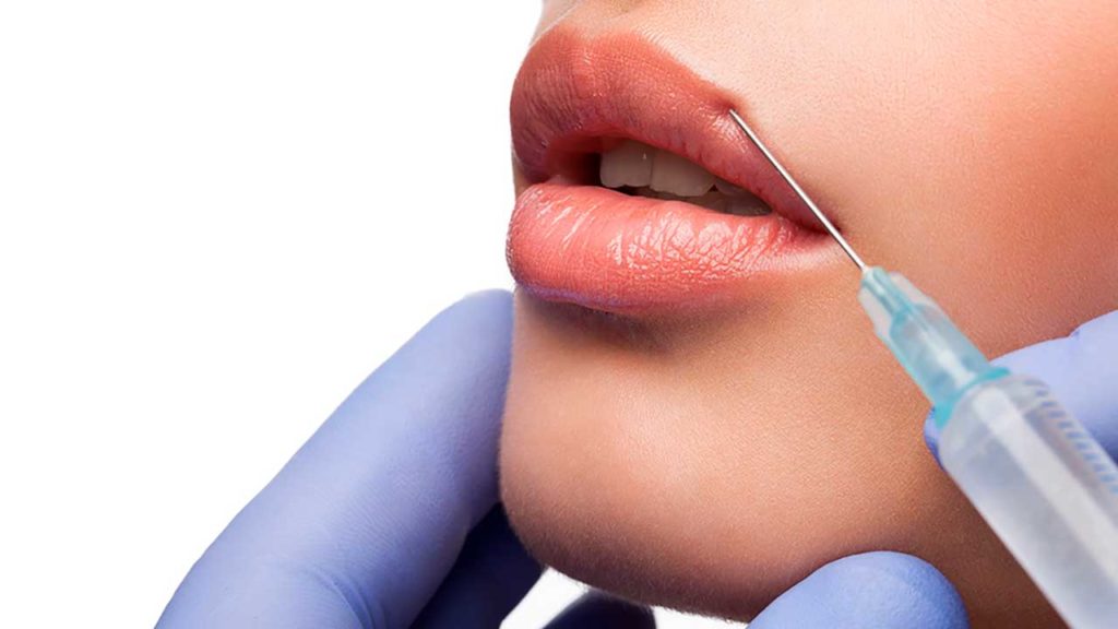 Lip Filler