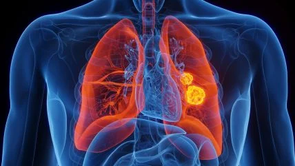 Why Is Non-Small Cell Lung Cancer (NSCLC)?